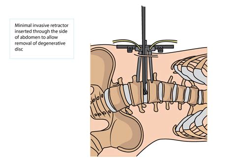 Minimally Invasive Oblique Lumbar Interbody Fusion Olif And Lateral