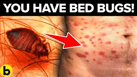 Rash Or Bite Warning Signs You May Have Bed Bugs Youtube