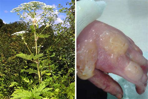 Wildlife Expert Warns Giant Hogweed Plant Can Cause Blindness Daily Star