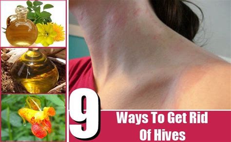 How To Get Rid Of Hives Urticaria Hive Home Home Remedies