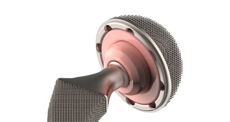 Trabtech Gains Funds For 3d Printed Hip Implants