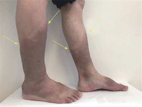 Figure 1 From Intralesional And Topical Glucocorticoids For Pretibial