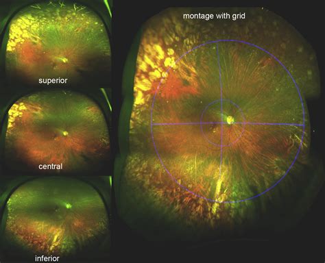 Peripheral Retinal Changes Associated With Age Related Macular