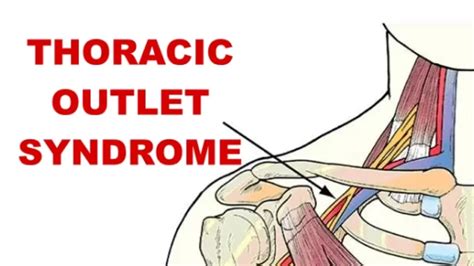 Thoracic Outlet Syndrome Vascular Archives Samarpan Physiotherapy Clinic
