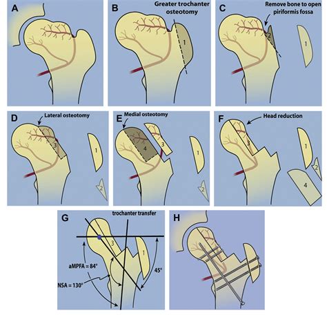 Figure 1 From The Treatment Of Femoral Head Deformity And Coxa Magna By