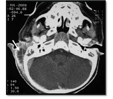 Ct Scan Axial Plane Showed Acute Mastoiditis Complicated By The Best