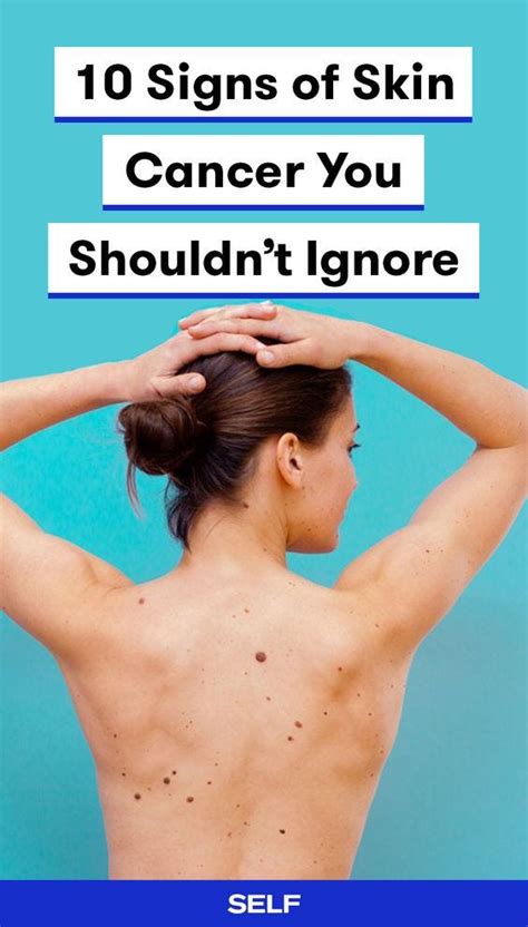 10 Signs Of Skin Cancer You Shouldnt Ignore Paula Medium
