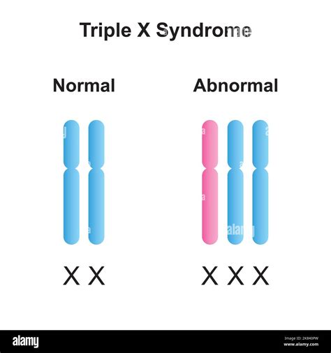 Scientific Designing Of Triple X Syndrome Trisomy X Colorful Symbols Vector Illustration