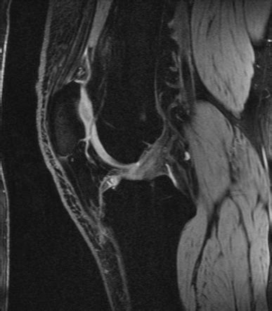 Chondromalacia Patellae Image Radiopaedia Org