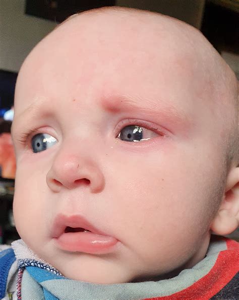 Sons Eye Tired Eczema Allergy Or Bruised Babycentre