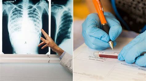 How Tuberculosis Is Diagnosed Screenings And Tests