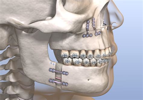Jaw Surgery Specialist Flowood Ms Oral And Facial Surgery Of