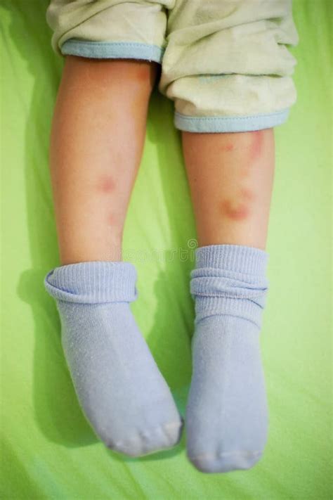Child Legs With Bruises Stock Image Image Of Hurt Health 24041963