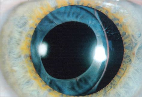 Zonular Dehiscence At The Time Of Combined Vitrectomy And Cataract