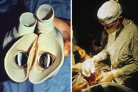 50th Anniversary Of The Worlds First Total Artificial Heart The