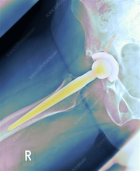 Total Hip Replacement X Ray Stock Image M6000388 Science Photo