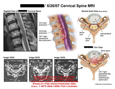 Cervical Spine Mri