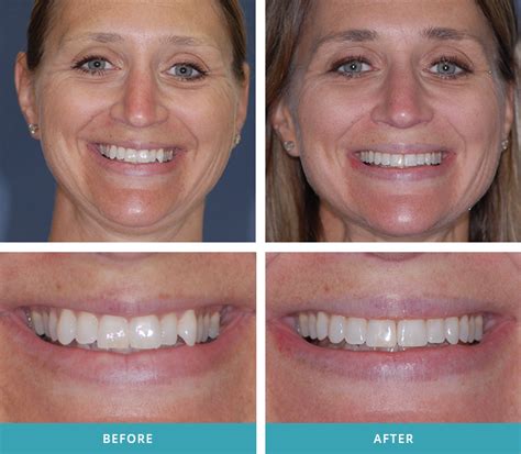 Invisalign Before And After Gaps Before And After