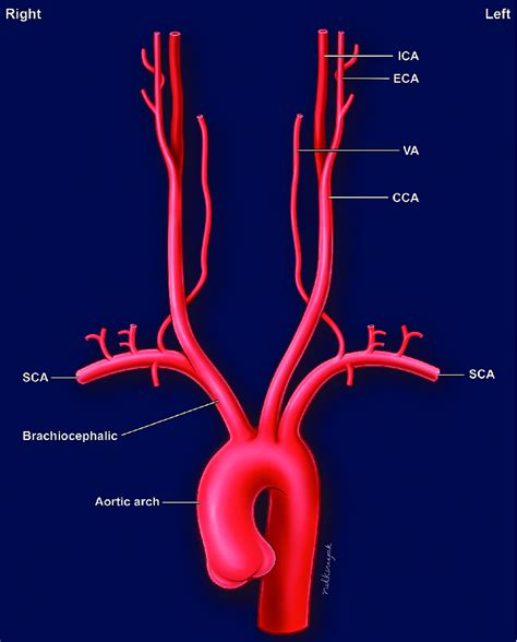 Branches Of The Aortic Arch And Extracranial Cerebral Arteries Va