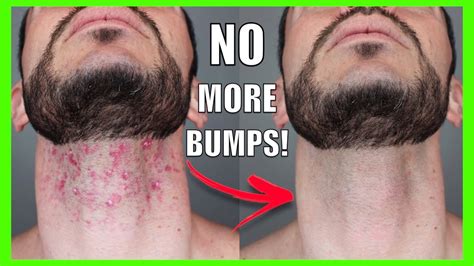 How To Get Rid Of RAZOR BUMPS INGROWN HAIR FAST Face Body