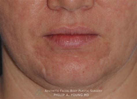 Acne Scar Treatment Before And After Photos Seattle Bellevue