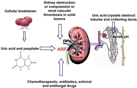 Identification of the specific histopathologic pattern of glomerular injury by renal biopsy is often the most helpful technique available for defining the cause of glomerulonephritis. Acute renal failure. Causes, symptoms, treatment Acute ...