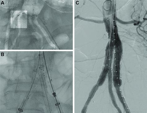 Digital Subtraction Angiography During Endovascular Aortic Aneurysm