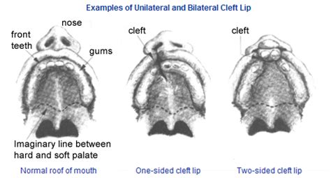 Cleft Lip And Cleft Palate Mcgovern Medical School