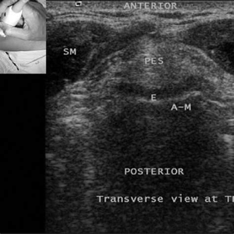 Pdf Ultrasound Of The Airway