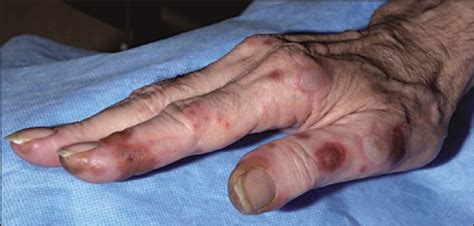 Leukocytoclastic Vasculitis Masquerading As Hand Foot Syndrome In A