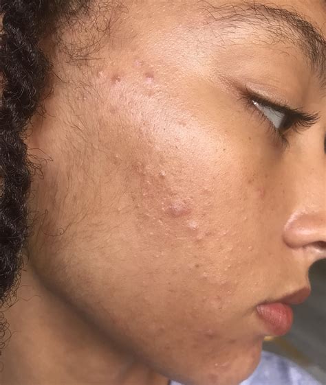 Acne I Cannot Clear Up My Sensitive Oily Skin Advice Please R