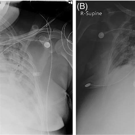 A Chest X‐ray On Covid‐19 Day 25 And B Chest X‐ray On Covid‐19 Day