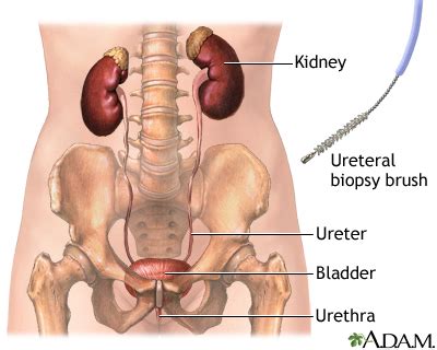 Ureteral Biopsy MedlinePlus Medical Encyclopedia Image