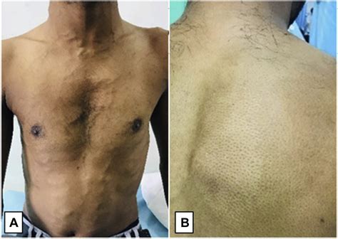 A 22 Year Old Man With Back Pain Dilated Veins Over Chest And Mass In