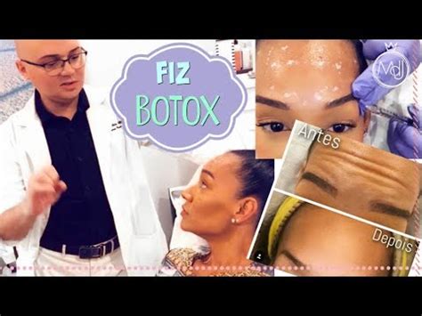 Tudo Sobre Meu Botox Minha Primeira Vez YouTube