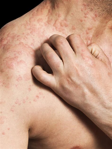 common shingles rash sites