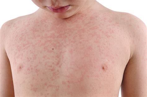 Common Skin Rashes And What To Do About Them Faculty Of Medicine