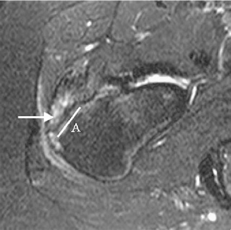 Mri And Us Of Gluteal Tendinopathy In Greater Trochanteric Pain