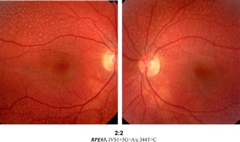 Fundus Albipunctatus Associated With Compound Heterozygous Mutations In