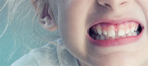 Почему дети скрипят зубами во сне Причины лечение