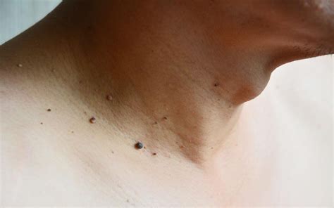 See more ideas about skin tag, skin, skin tag removal. Easy as 1, 2, 3… Minor Skin Conditions Eliminated in a ...