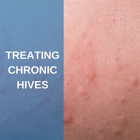 Treating Chronic Hives What Your Dermatologist Recommends