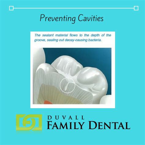 Dental Sealants The Simple Way To Prevent Cavities