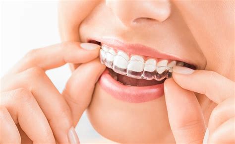 How Clear Braces Can Help You Achieve The Perfect Smile Toxnetlab