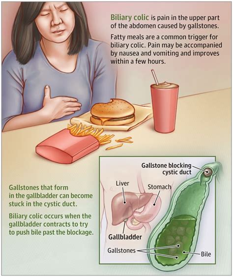 Gallstones And Biliary Colic Medical Surgical Nursing Pharmacology