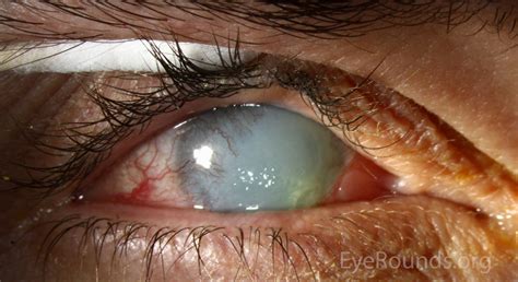 Painful Red Eye Causes Ophthalmology Geeky Medics