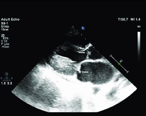 Transthoracic Echocardiography Showing Vegetation On Mitral And Aortic