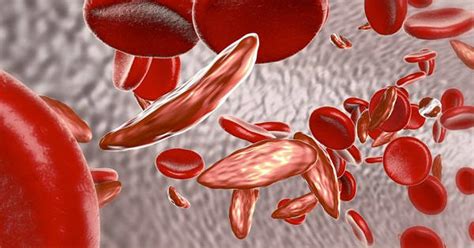 De Qué Trata La Anemia Falciforme Nexofin