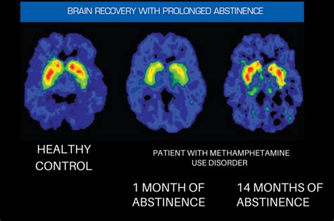 The Neuroscience Of Addiction Recovery Herenow Help