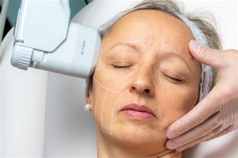 Hifu Face Lift Replace Anti Wrinkle Treatment Perfect Laser Clinics